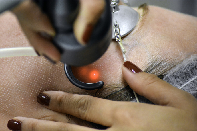 fractional laser 