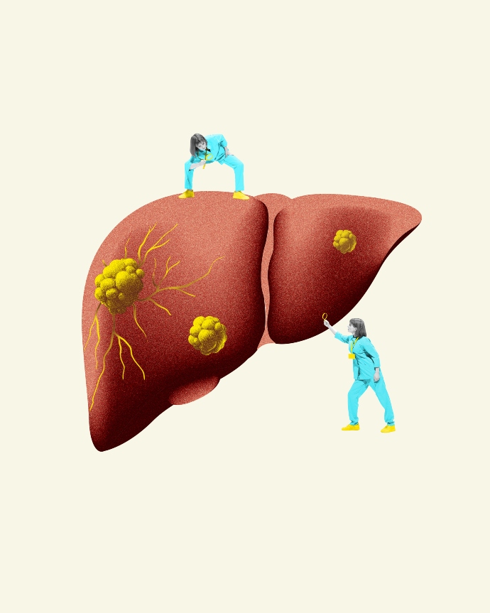 Ο καρκίνος που συχνά παραβλέπεται στις γυναίκες: Τα συμπτώματα που δεν πρέπει να αγνοείς